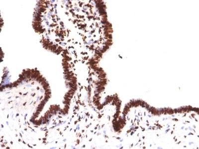 FFPE human ovarian carcinoma sections stained with 100 ul anti-Histone H1 (clone HH1/957) at 1:100. HIER epitope retrieval prior to staining was performed in 10mM Citrate, pH 6.0.